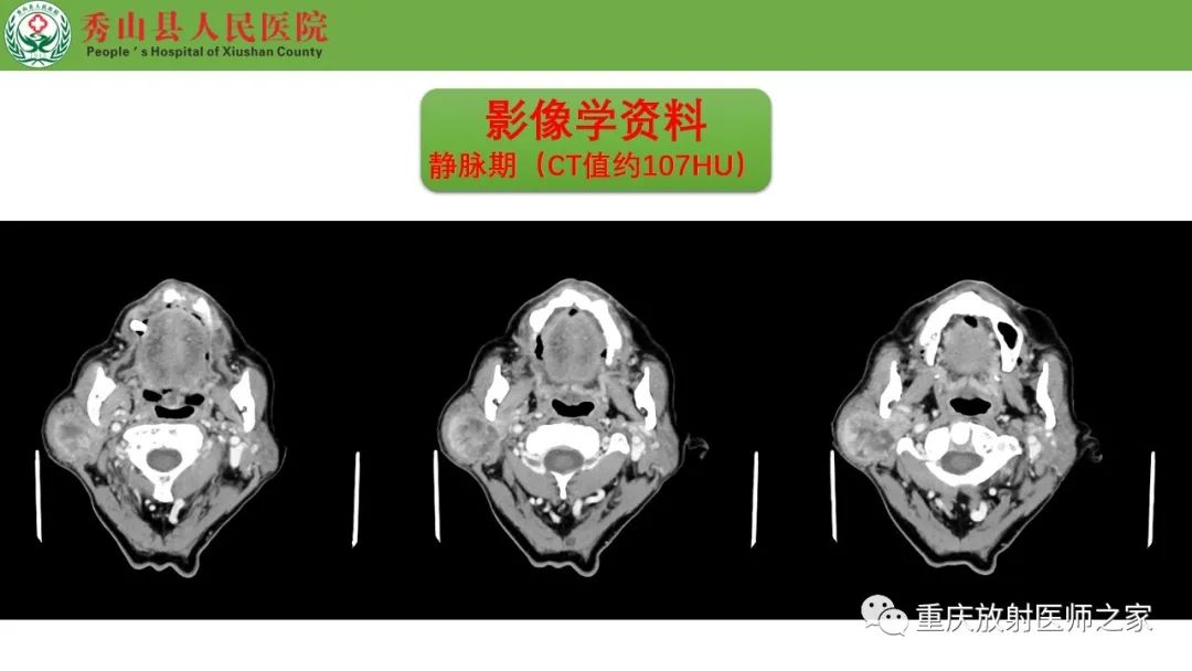 影像PPT - 【病例】腮腺基底细胞腺瘤1例CT影像-9