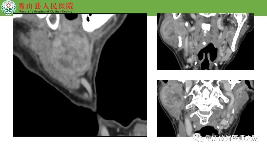 影像PPT - 【病例】腮腺基底细胞腺瘤1例CT影像-11