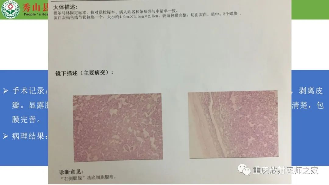影像PPT - 【病例】腮腺基底细胞腺瘤1例CT影像-13