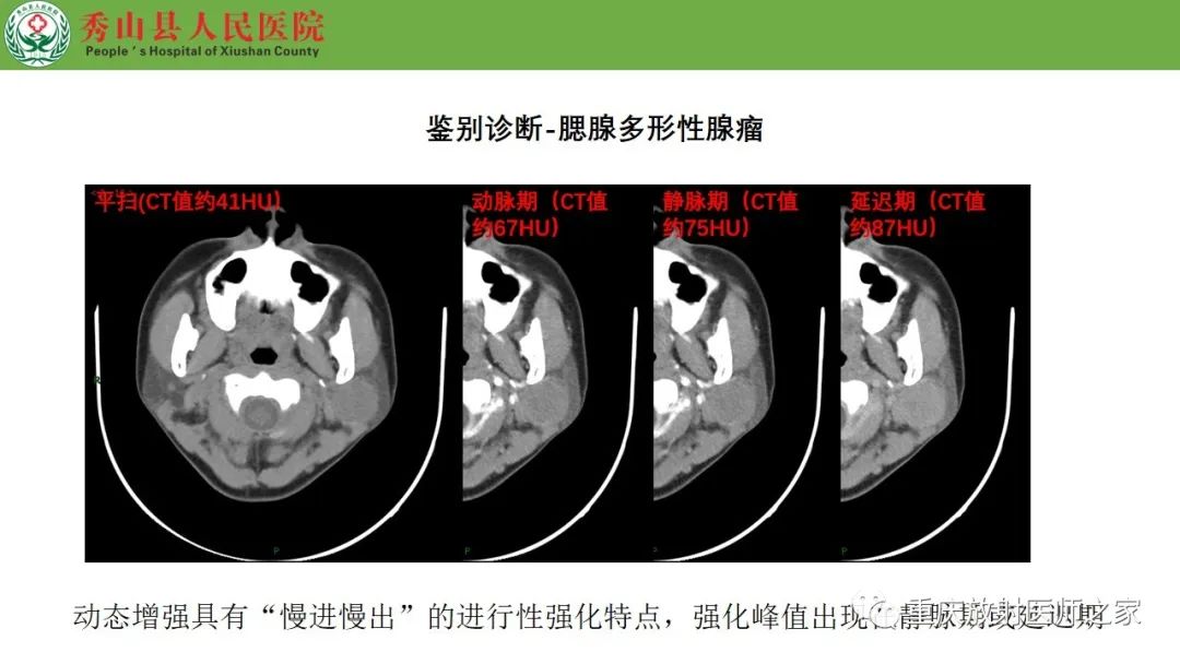影像PPT - 【病例】腮腺基底细胞腺瘤1例CT影像-17