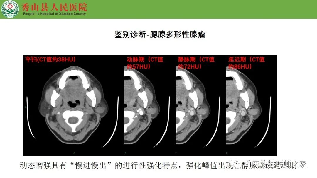 影像PPT - 【病例】腮腺基底细胞腺瘤1例CT影像-18