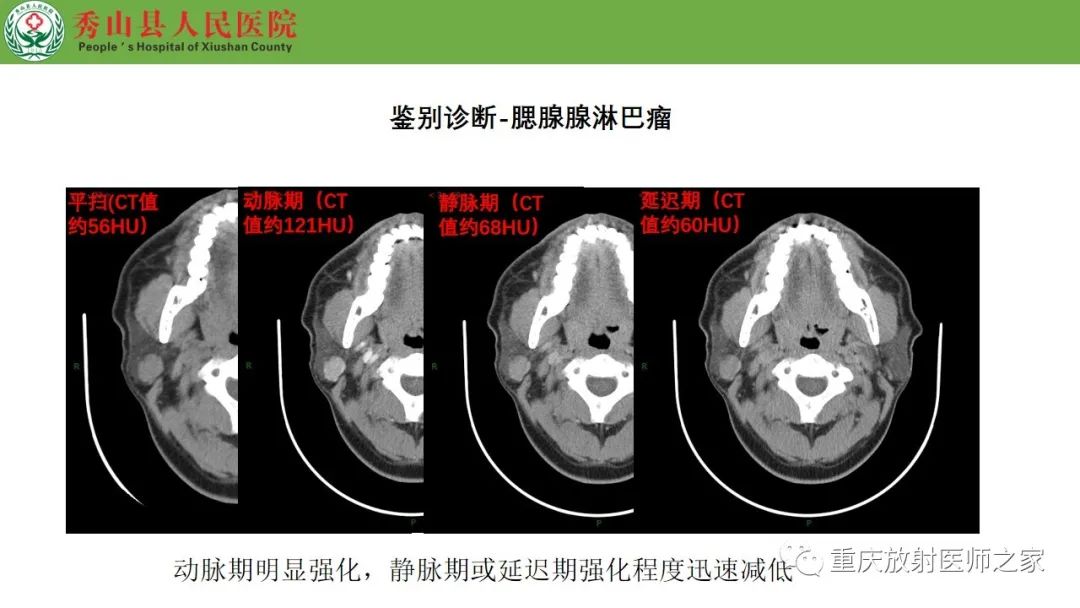 影像PPT - 【病例】腮腺基底细胞腺瘤1例CT影像-19