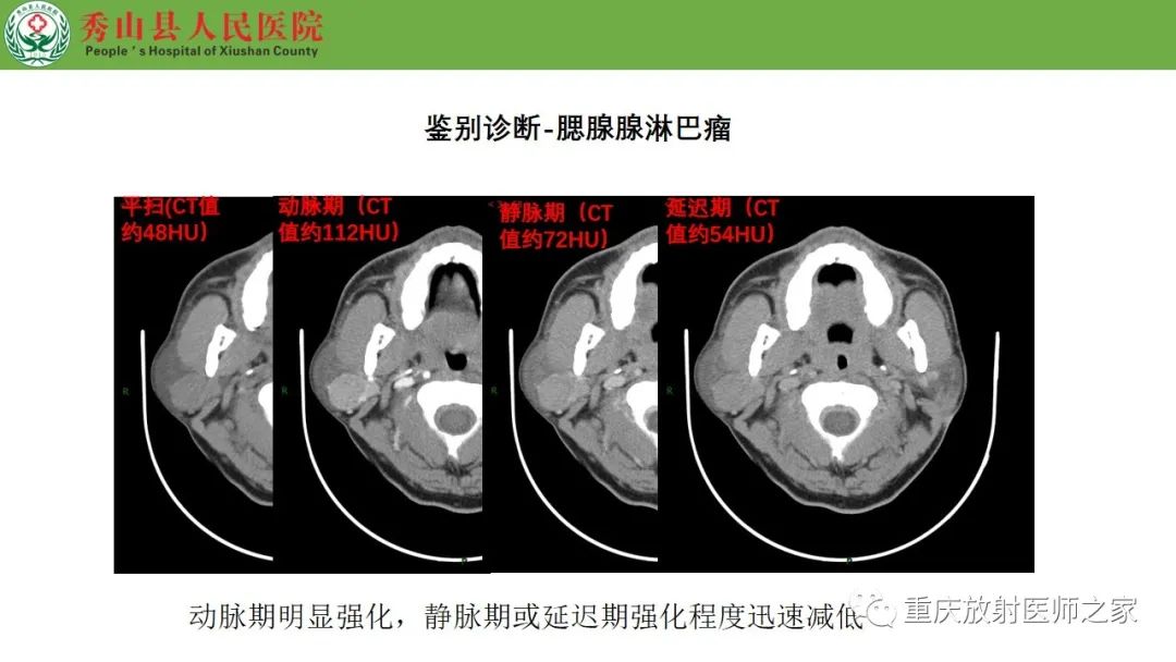 影像PPT - 【病例】腮腺基底细胞腺瘤1例CT影像-20