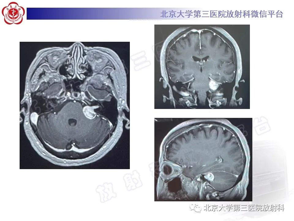 影像PPT - 【PPT】桥小脑角区肿瘤-4