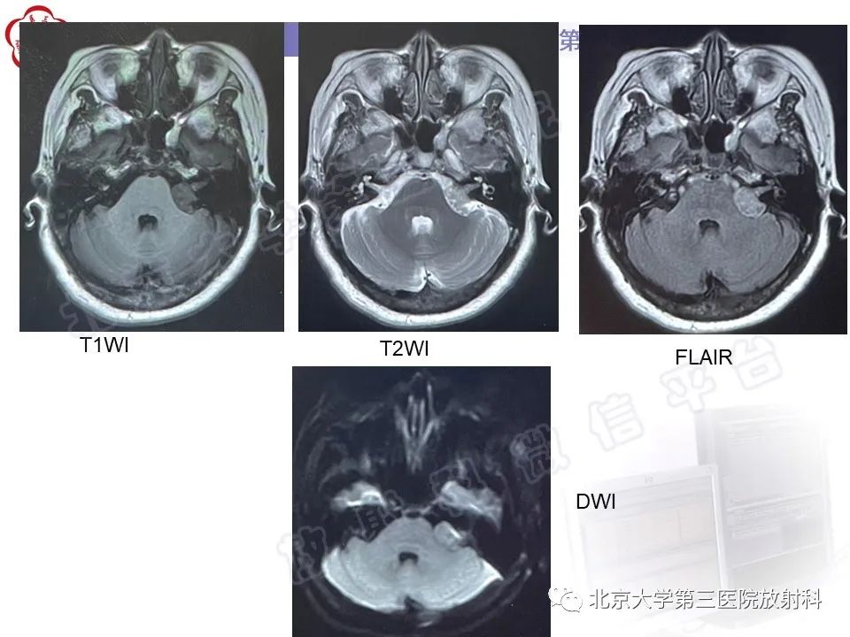 影像PPT - 【PPT】桥小脑角区肿瘤-3