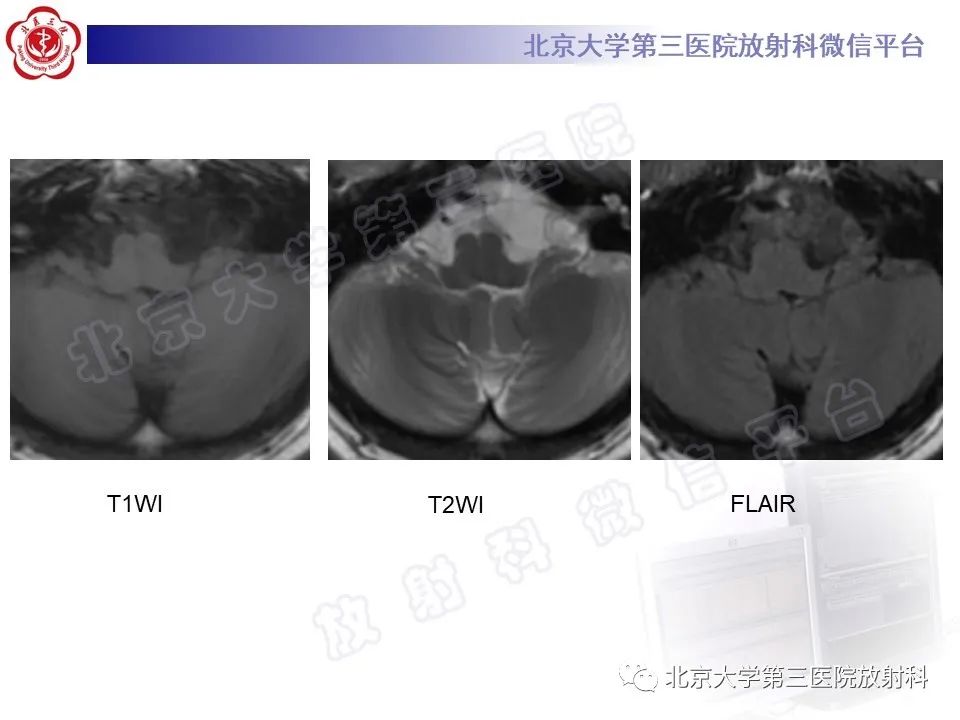 影像PPT - 【PPT】桥小脑角区肿瘤-10