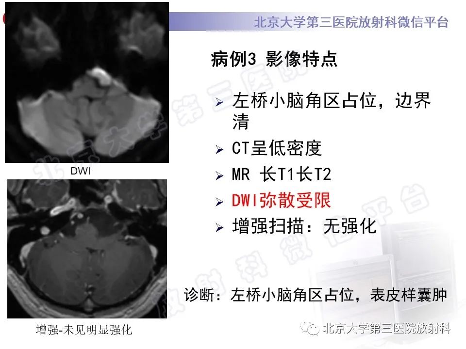 影像PPT - 【PPT】桥小脑角区肿瘤-11