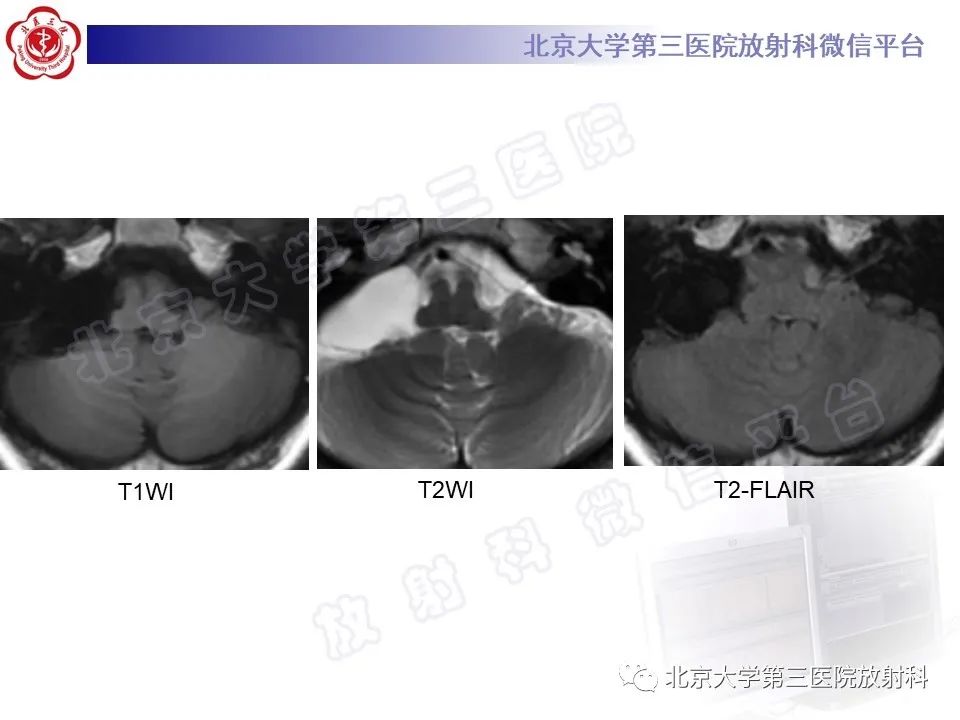 影像PPT - 【PPT】桥小脑角区肿瘤-13