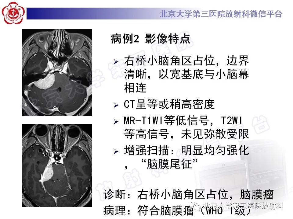 影像PPT - 【PPT】桥小脑角区肿瘤-8