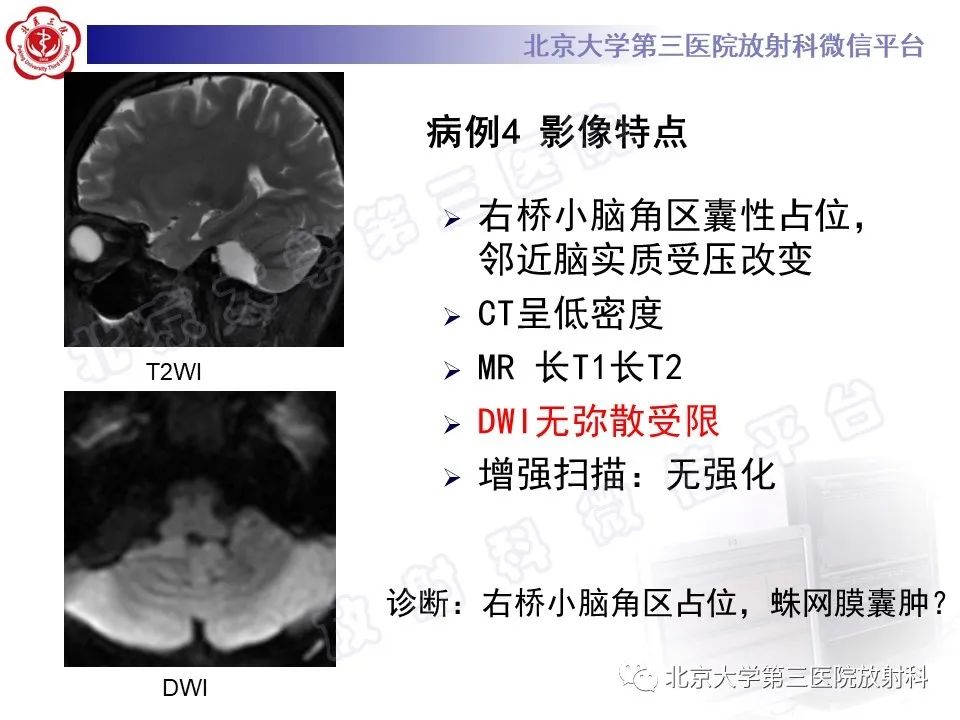 影像PPT - 【PPT】桥小脑角区肿瘤-14