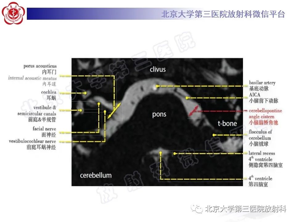 影像PPT - 【PPT】桥小脑角区肿瘤-16