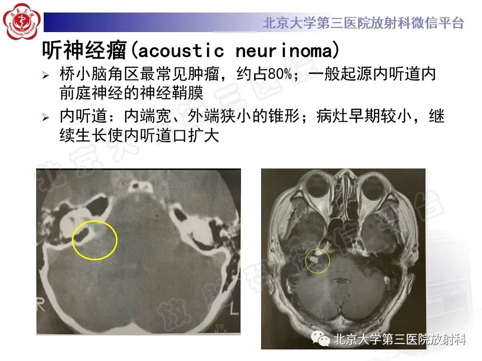 影像PPT - 【PPT】桥小脑角区肿瘤-18