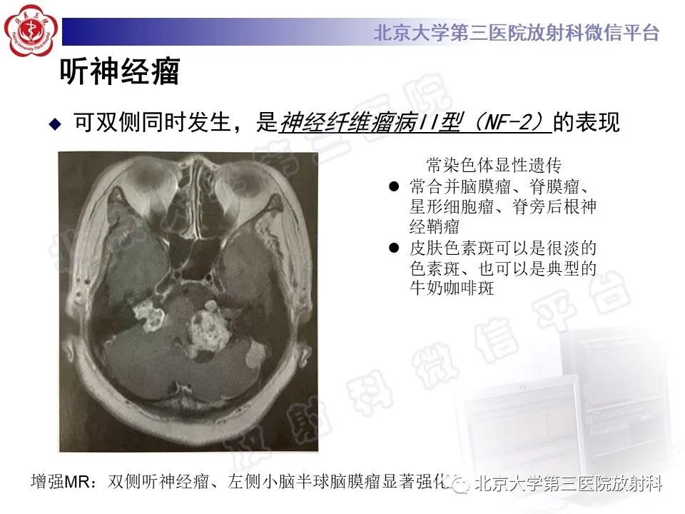 影像PPT - 【PPT】桥小脑角区肿瘤-20
