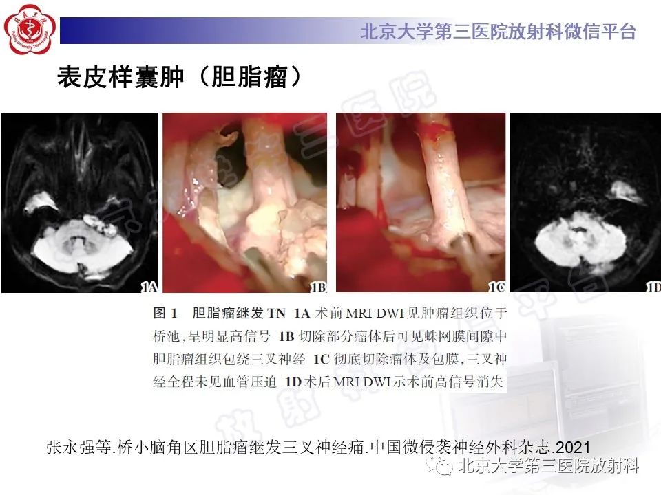 影像PPT - 【PPT】桥小脑角区肿瘤-22