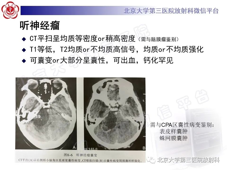 影像PPT - 【PPT】桥小脑角区肿瘤-19