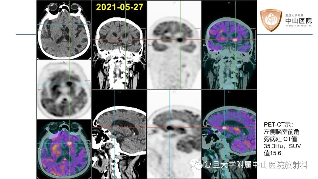 影像PPT - 【病例】原发性中枢神经系统淋巴瘤1例MR影像-5
