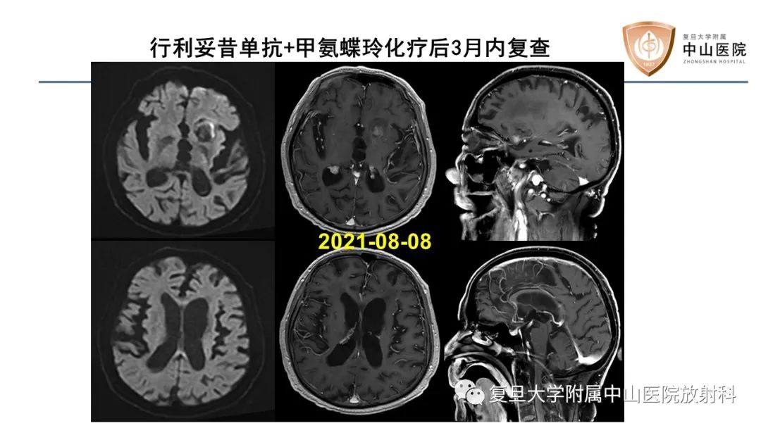 影像PPT - 【病例】原发性中枢神经系统淋巴瘤1例MR影像-8