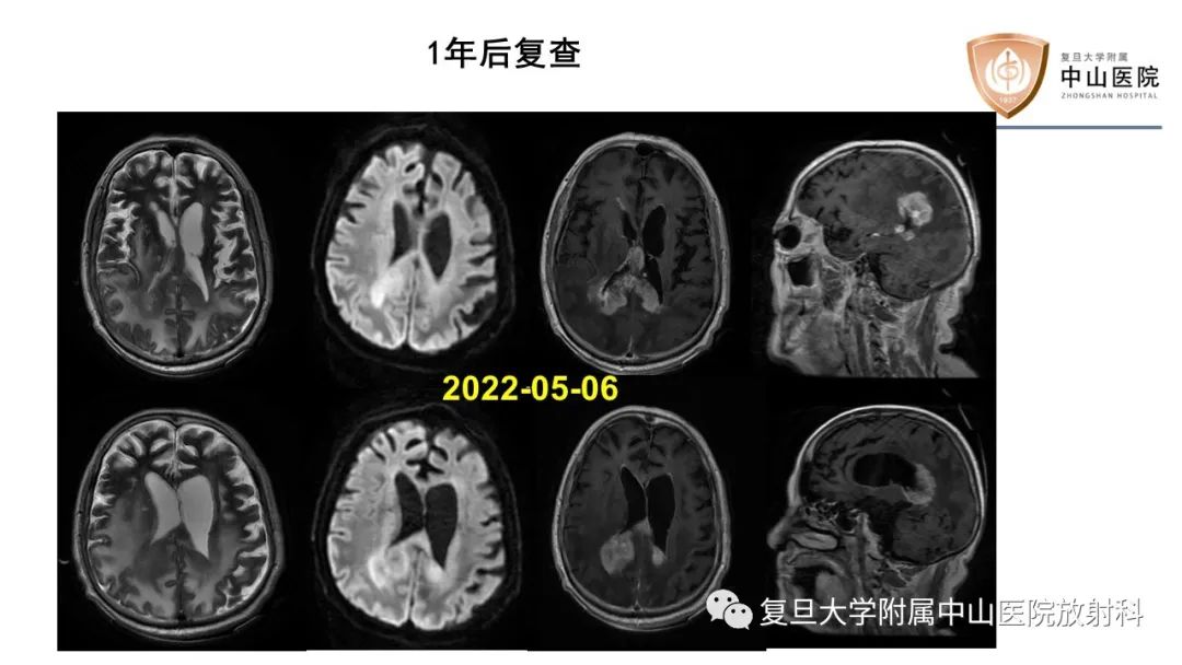 影像PPT - 【病例】原发性中枢神经系统淋巴瘤1例MR影像-9