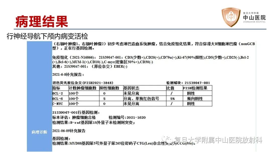 影像PPT - 【病例】原发性中枢神经系统淋巴瘤1例MR影像-7