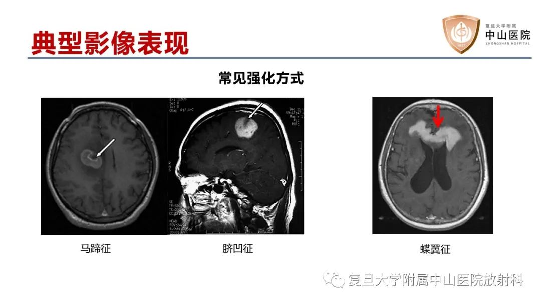 影像PPT - 【病例】原发性中枢神经系统淋巴瘤1例MR影像-12