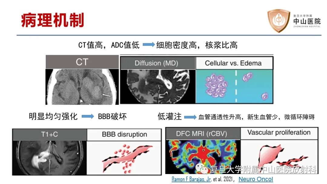 影像PPT - 【病例】原发性中枢神经系统淋巴瘤1例MR影像-13