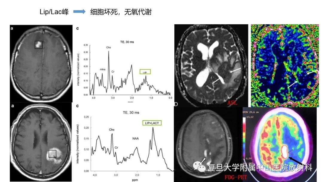 影像PPT - 【病例】原发性中枢神经系统淋巴瘤1例MR影像-14