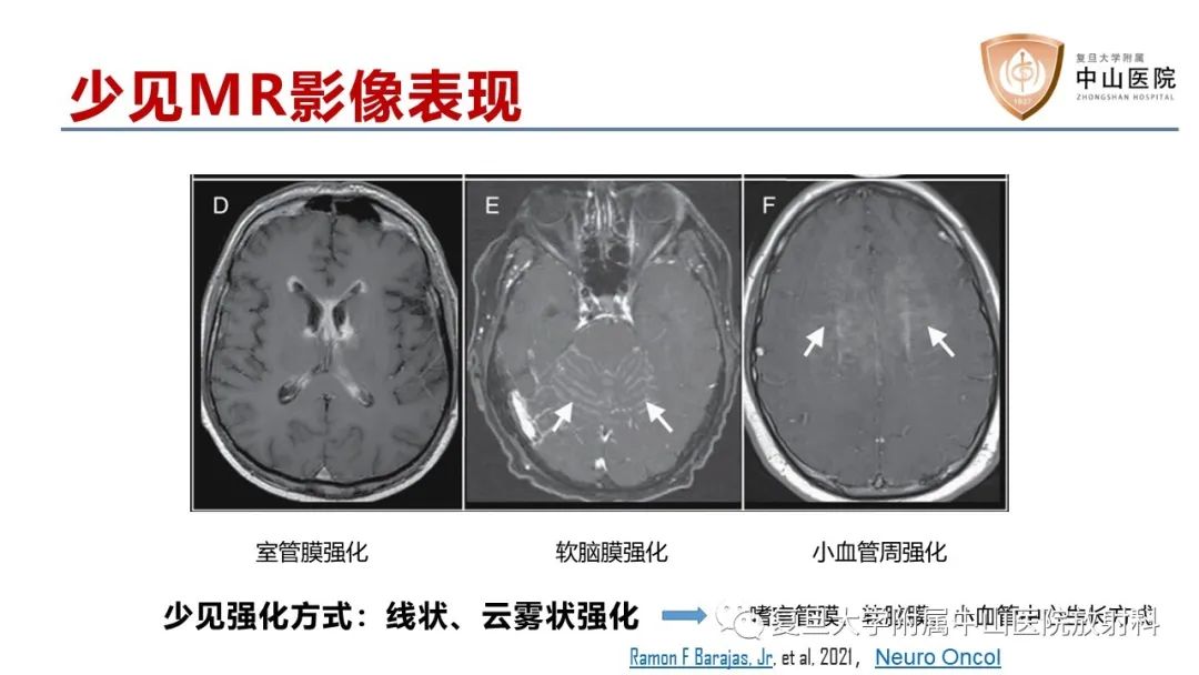 影像PPT - 【病例】原发性中枢神经系统淋巴瘤1例MR影像-15