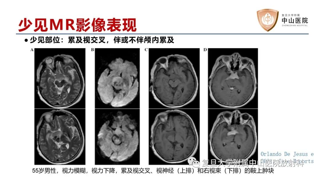 影像PPT - 【病例】原发性中枢神经系统淋巴瘤1例MR影像-16