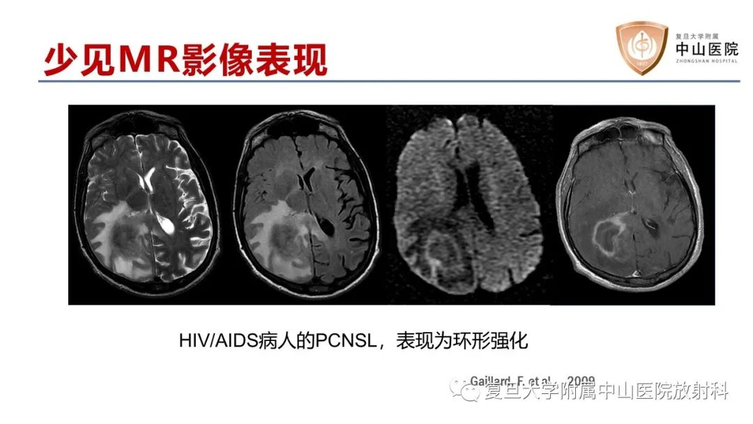 影像PPT - 【病例】原发性中枢神经系统淋巴瘤1例MR影像-17