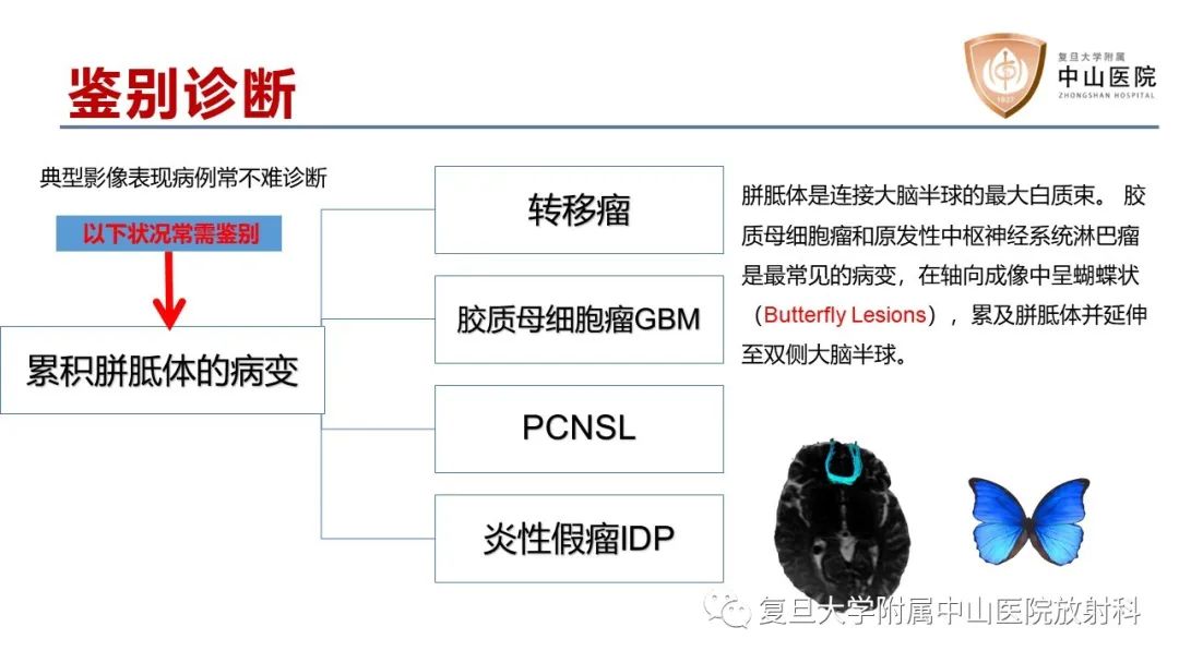 影像PPT - 【病例】原发性中枢神经系统淋巴瘤1例MR影像-18
