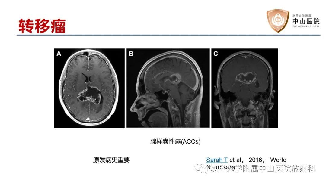 影像PPT - 【病例】原发性中枢神经系统淋巴瘤1例MR影像-20