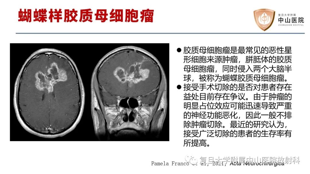 影像PPT - 【病例】原发性中枢神经系统淋巴瘤1例MR影像-19