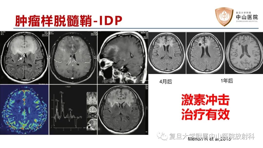 影像PPT - 【病例】原发性中枢神经系统淋巴瘤1例MR影像-21