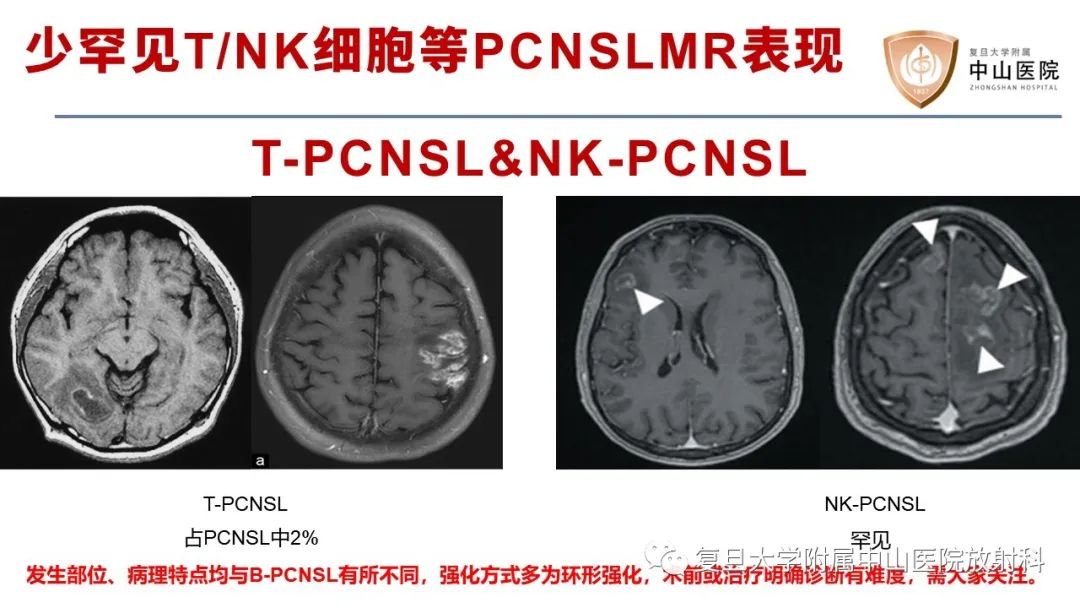 影像PPT - 【病例】原发性中枢神经系统淋巴瘤1例MR影像-26