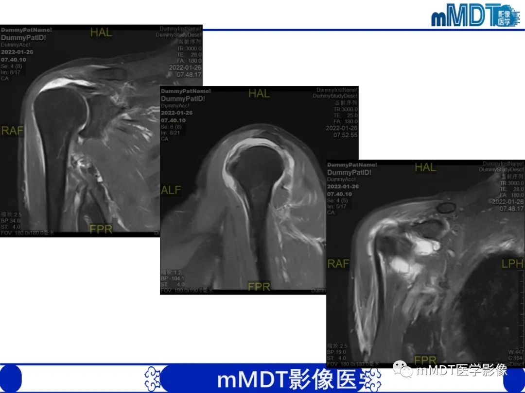 影像PPT - 【PPT】肩关节撞击综合征-2