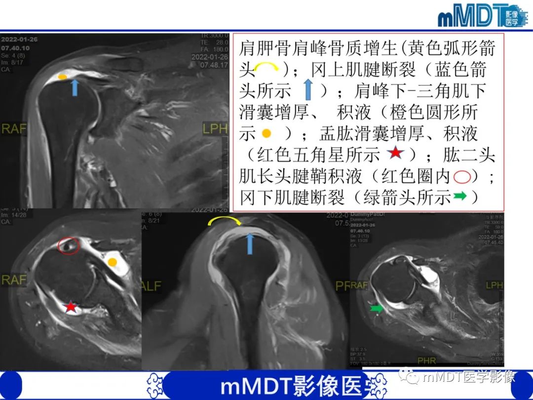 影像PPT - 【PPT】肩关节撞击综合征-5