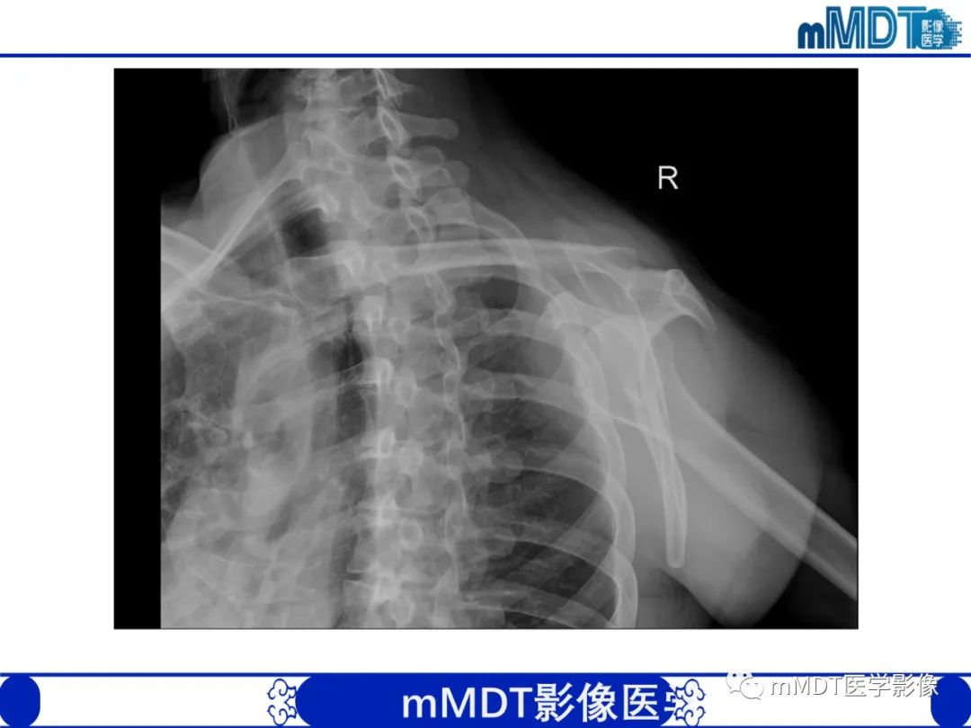 影像PPT - 【PPT】肩关节撞击综合征-11