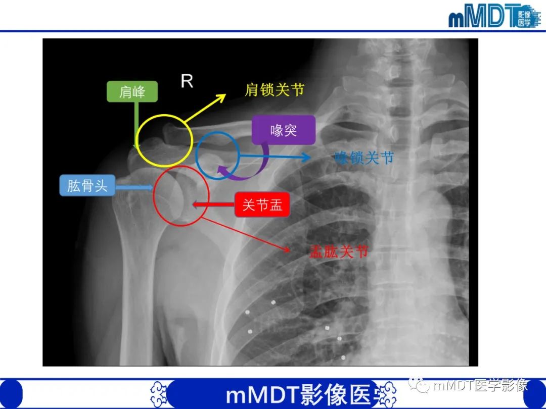 影像PPT - 【PPT】肩关节撞击综合征-10