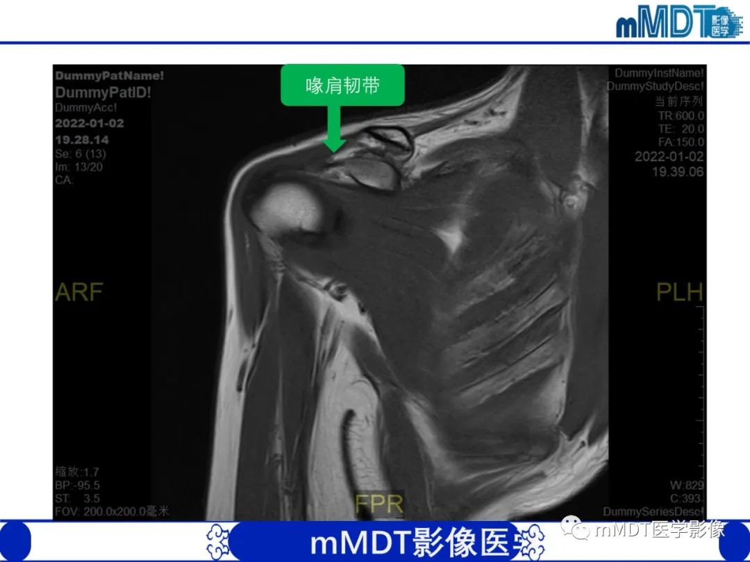 影像PPT - 【PPT】肩关节撞击综合征-14