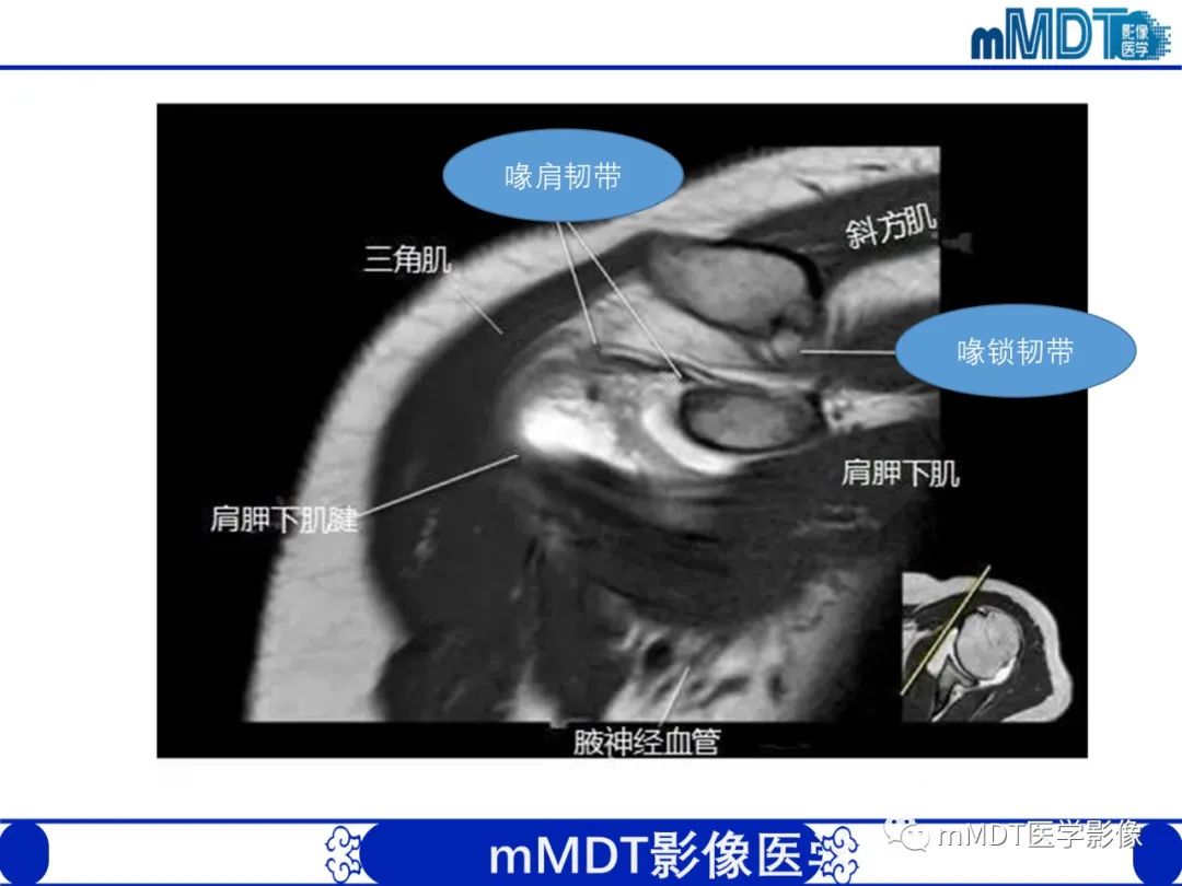 影像PPT - 【PPT】肩关节撞击综合征-15