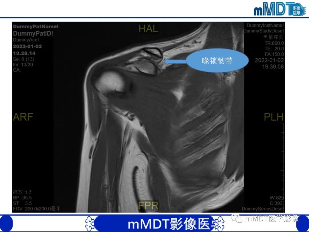 影像PPT - 【PPT】肩关节撞击综合征-16