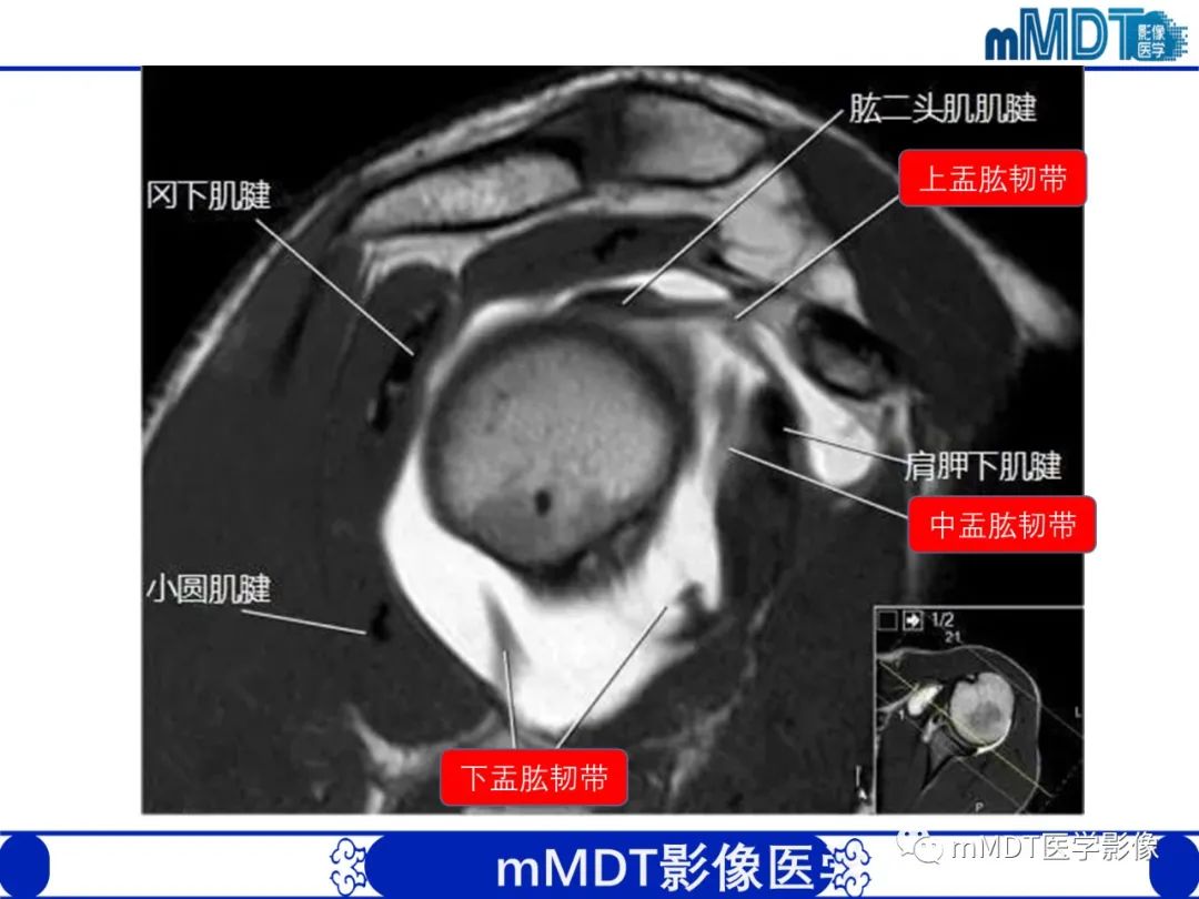 影像PPT - 【PPT】肩关节撞击综合征-17