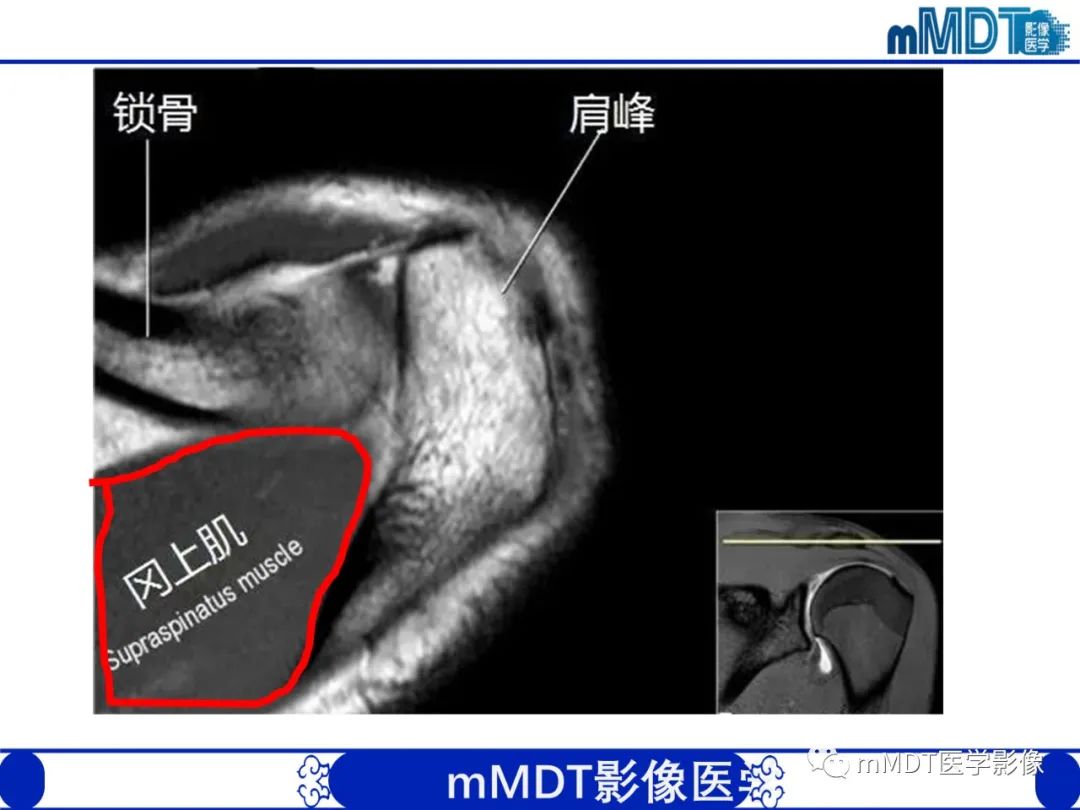 影像PPT - 【PPT】肩关节撞击综合征-20