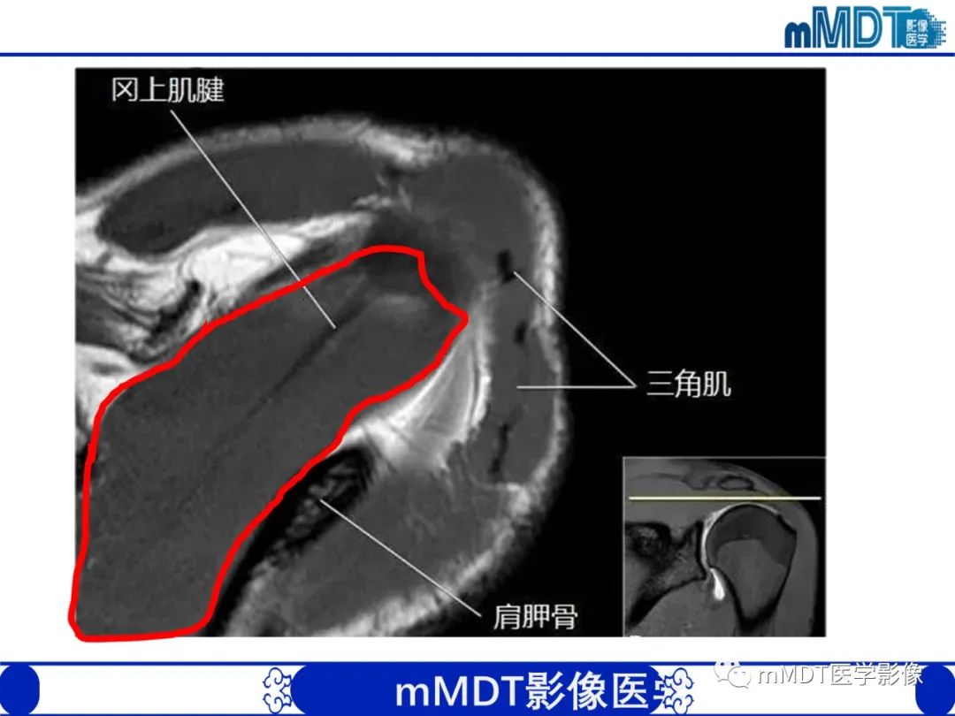 影像PPT - 【PPT】肩关节撞击综合征-21