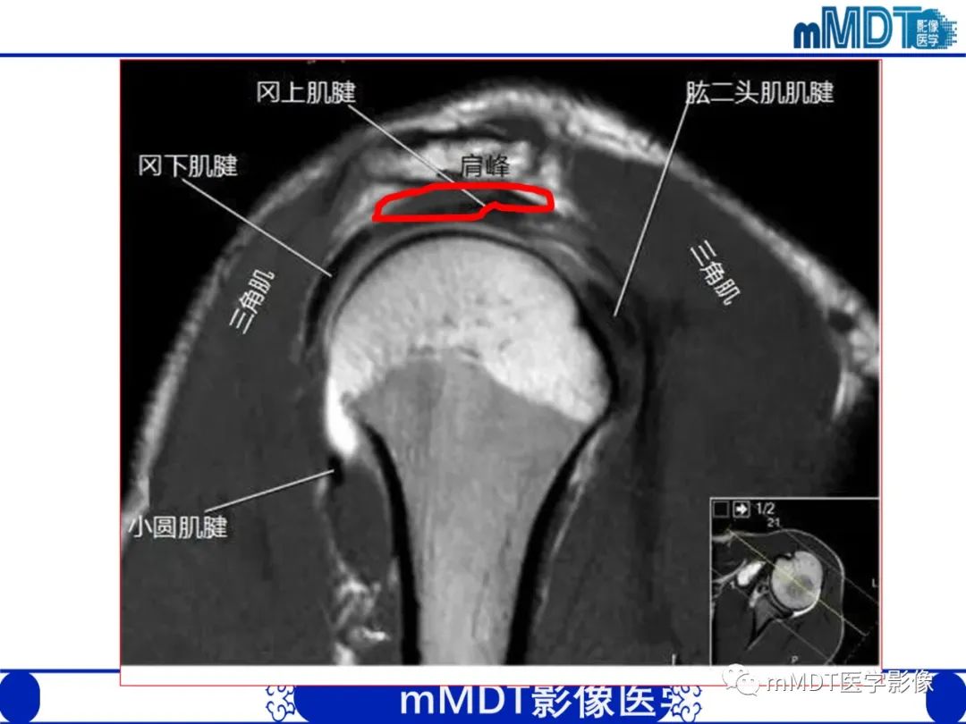 影像PPT - 【PPT】肩关节撞击综合征-23
