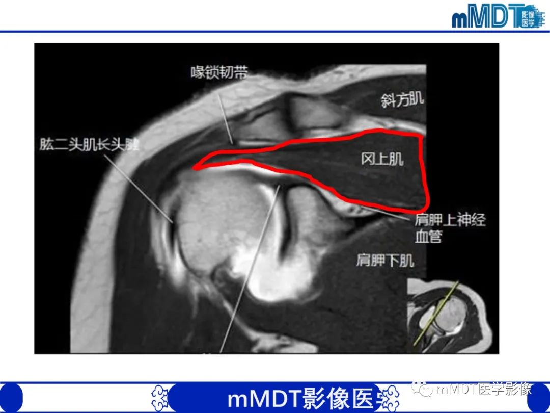 影像PPT - 【PPT】肩关节撞击综合征-22