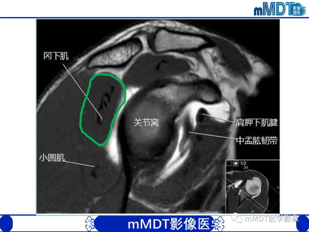 影像PPT - 【PPT】肩关节撞击综合征-25