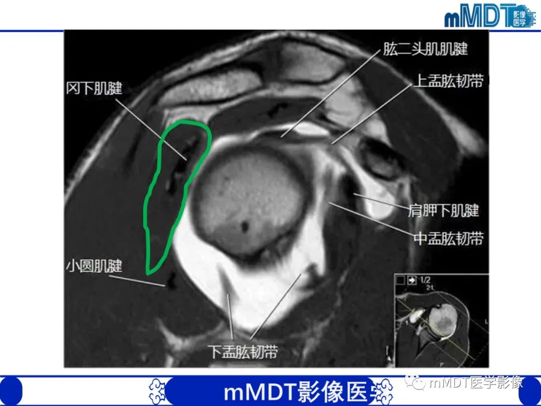 影像PPT - 【PPT】肩关节撞击综合征-26