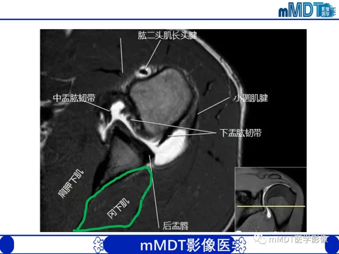 影像PPT - 【PPT】肩关节撞击综合征-27