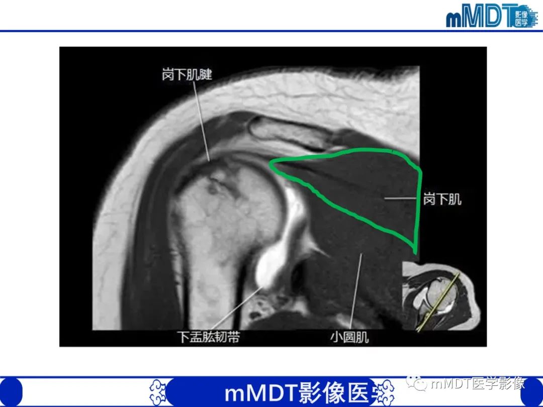 影像PPT - 【PPT】肩关节撞击综合征-28